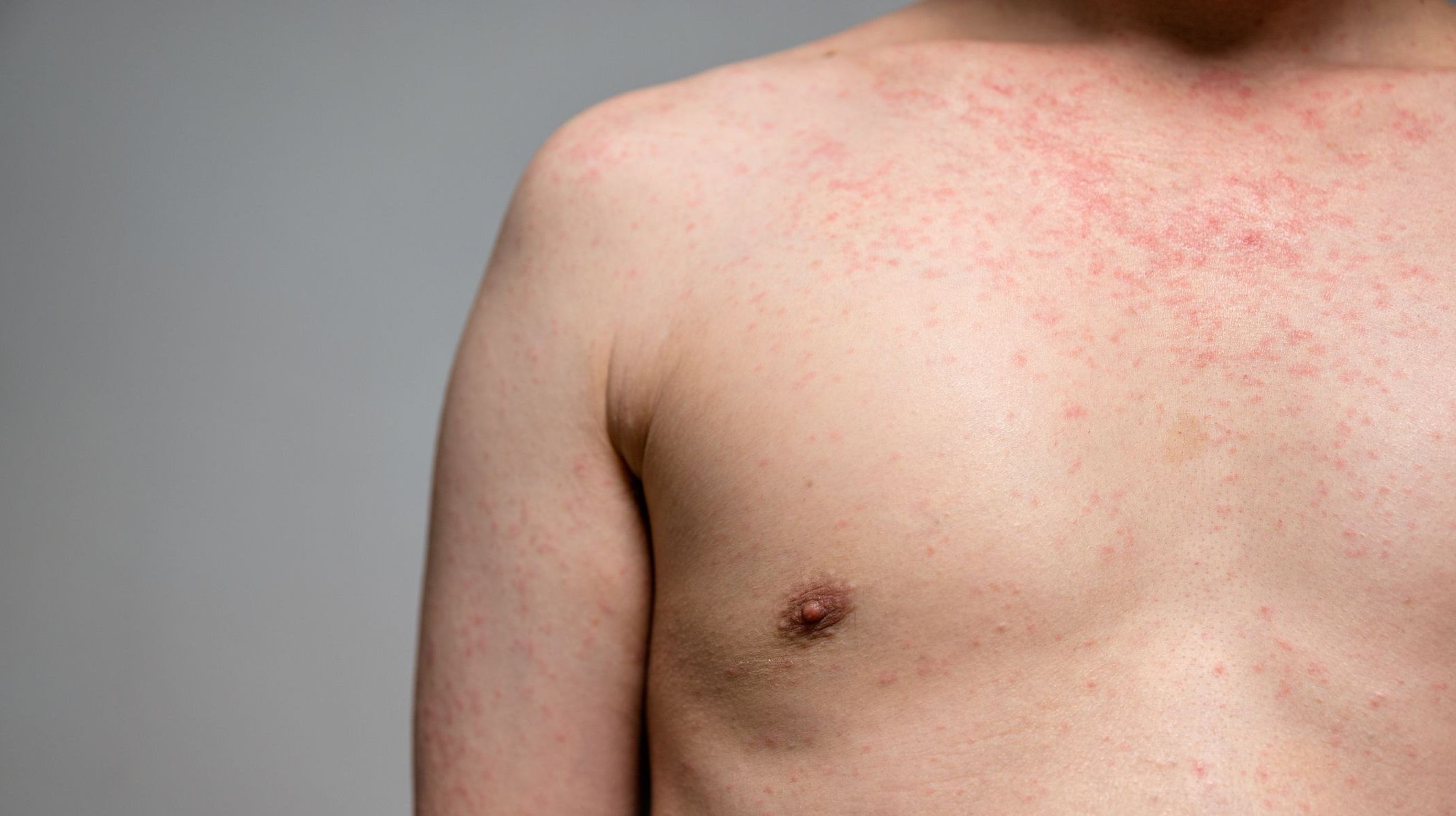 7 respostas para se proteger contra o sarampo, que volta a preocupar